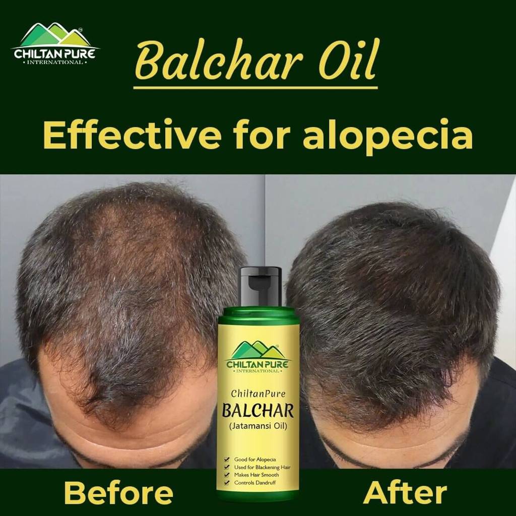 balchar-jatamansi-oil-effective-for-alopecia-enlarges-follicular-hair-size-prevents-scalp-infections-120ml-778335