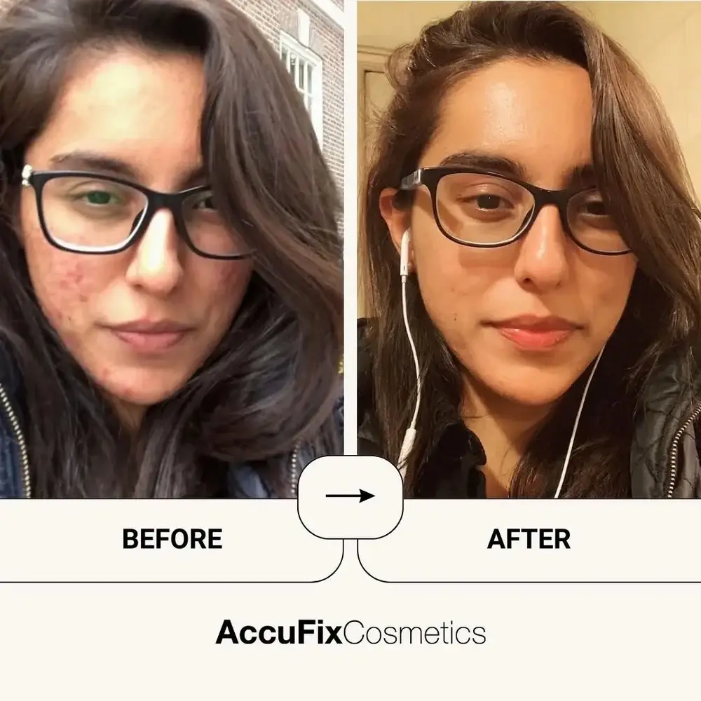 Before_After_result_of_AcuFix_s_User